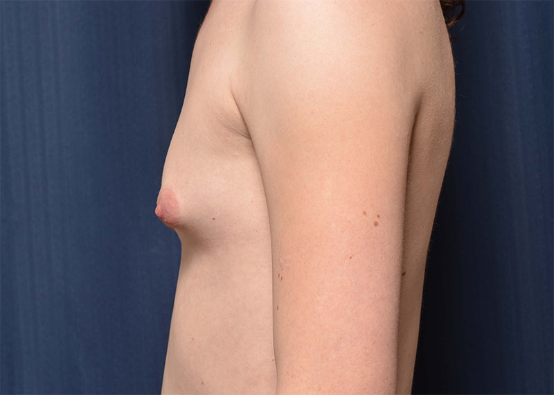 Transition Top Surgery