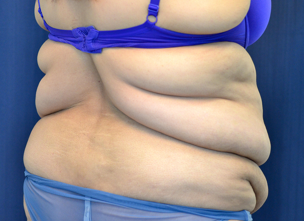 Tummy Tuck