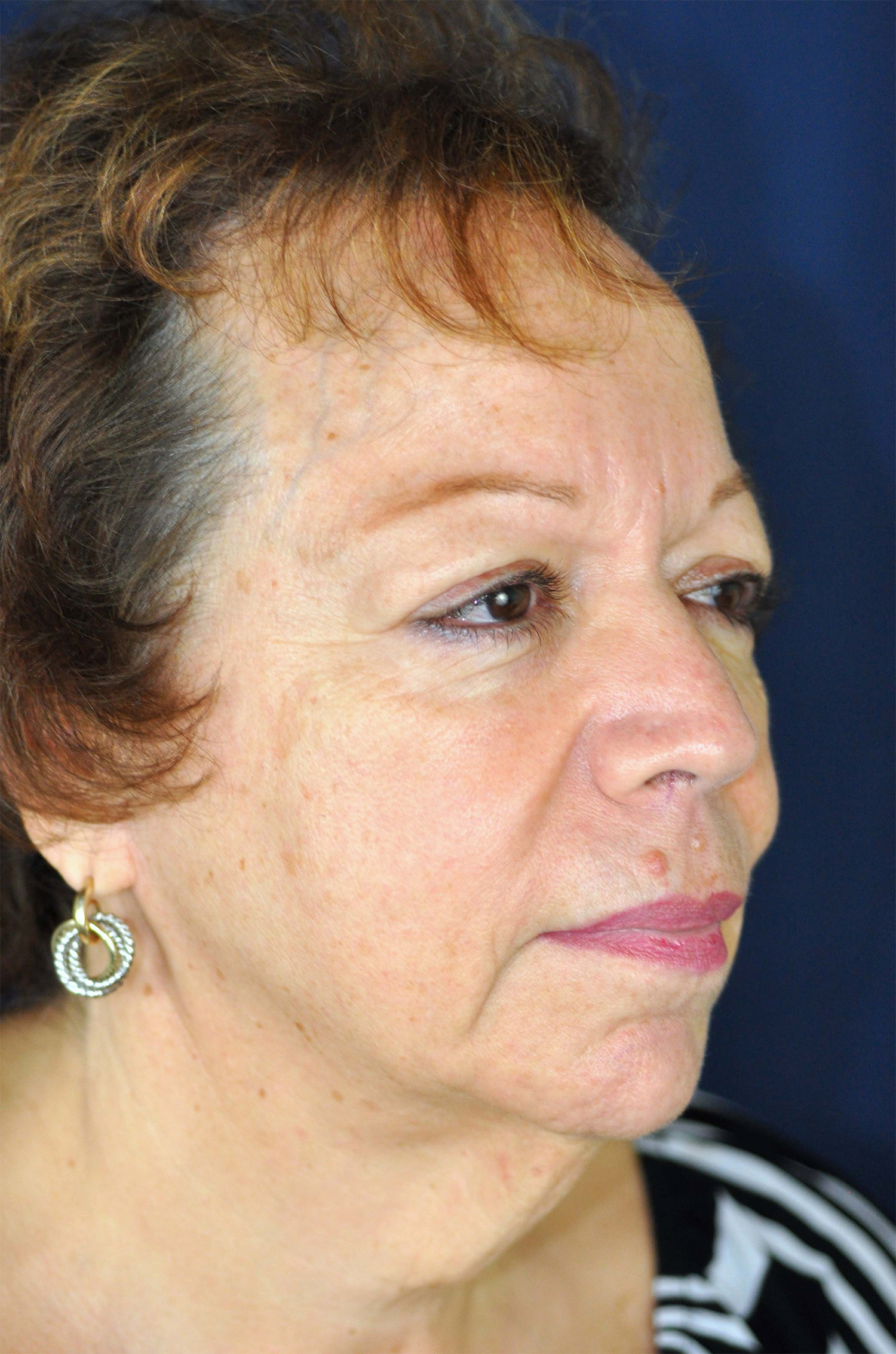 Facelift / Neck Lift