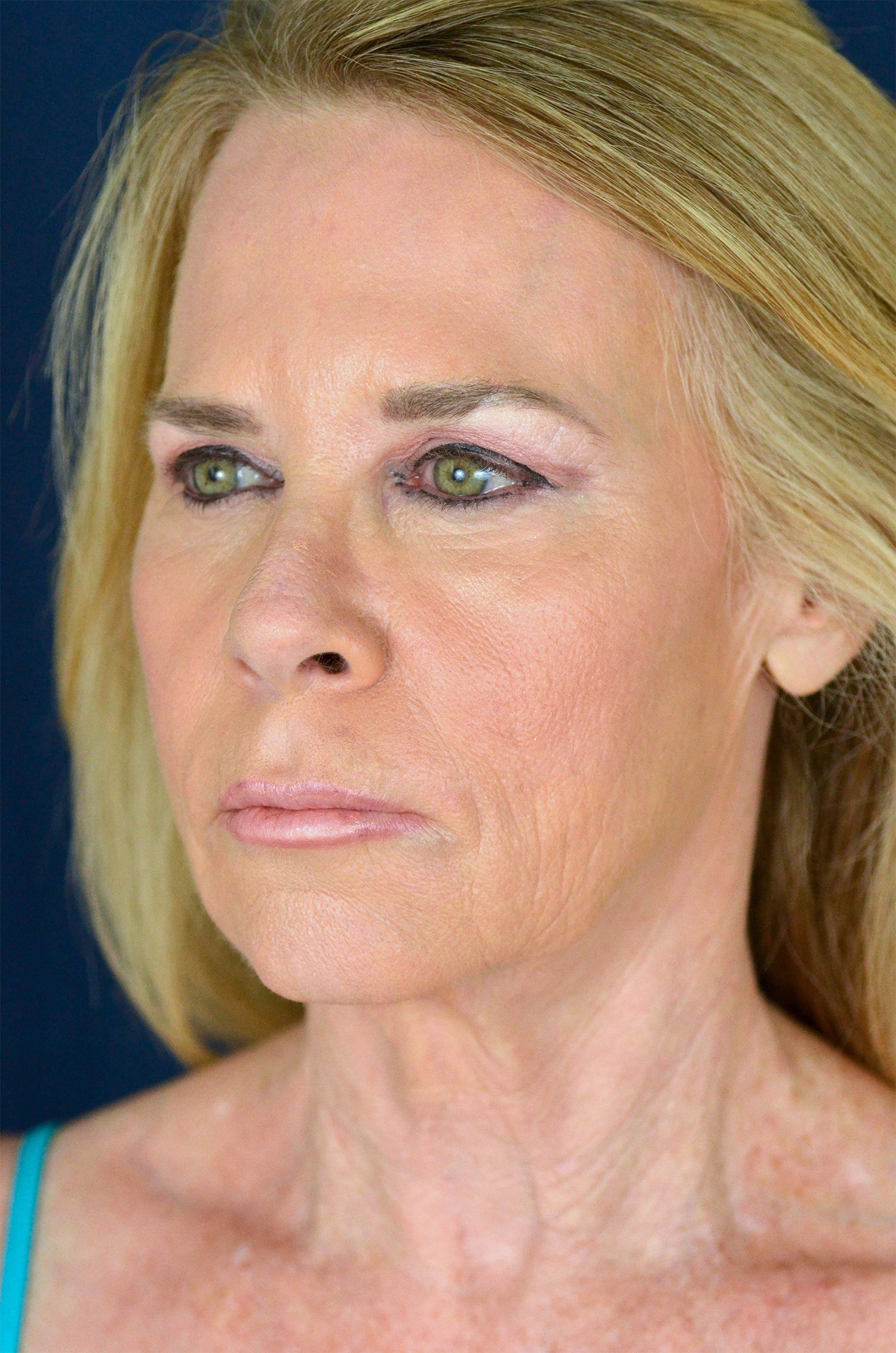 Facelift / Neck Lift