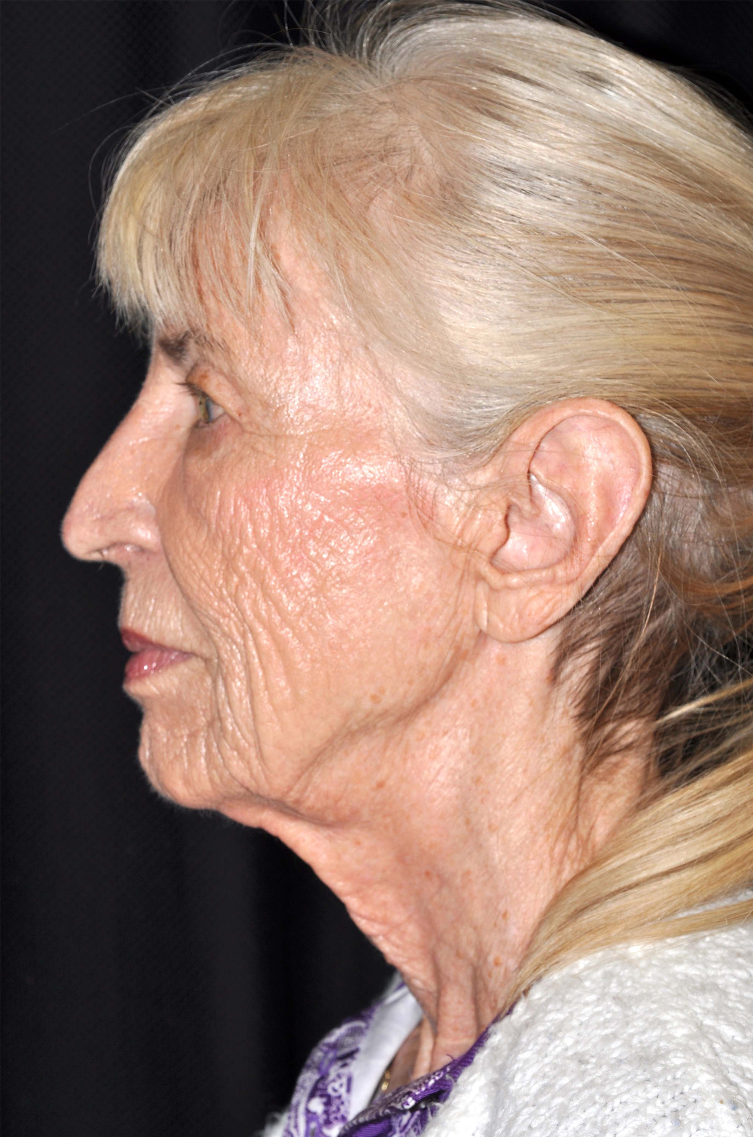 Facelift / Neck Lift