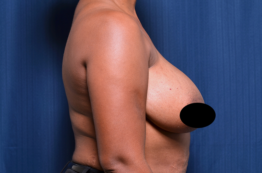 Breast Lift Reduction