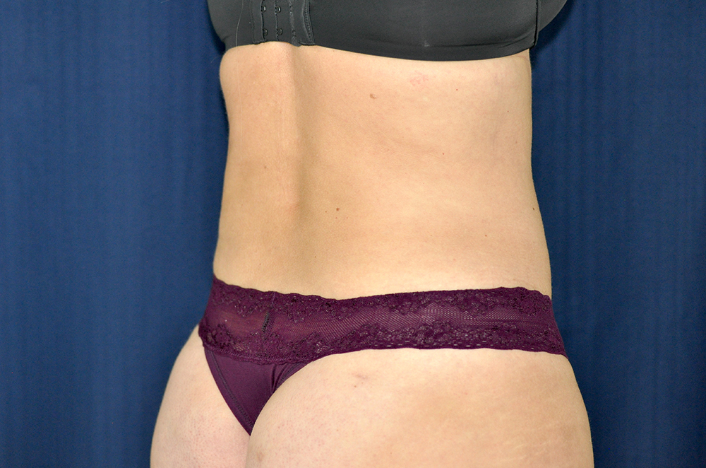 Liposuction