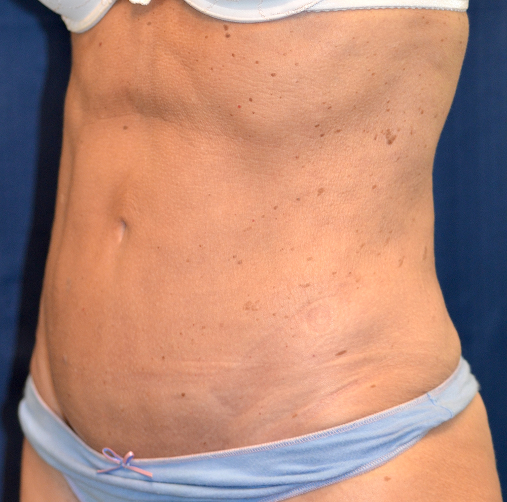 Tummy Tuck