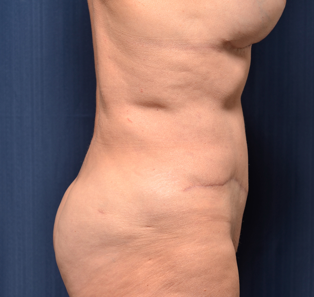 Tummy Tuck