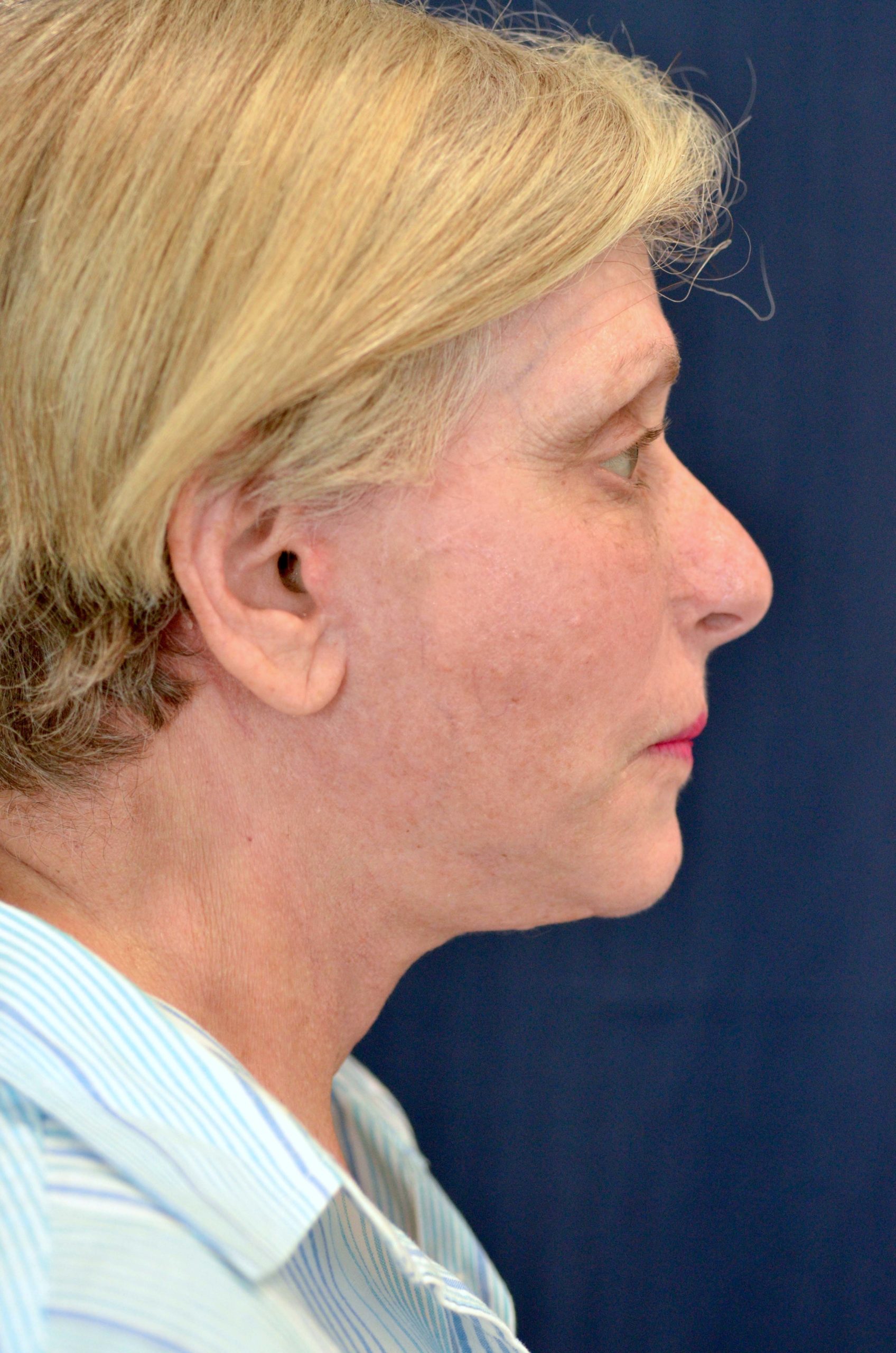 Facelift / Neck Lift