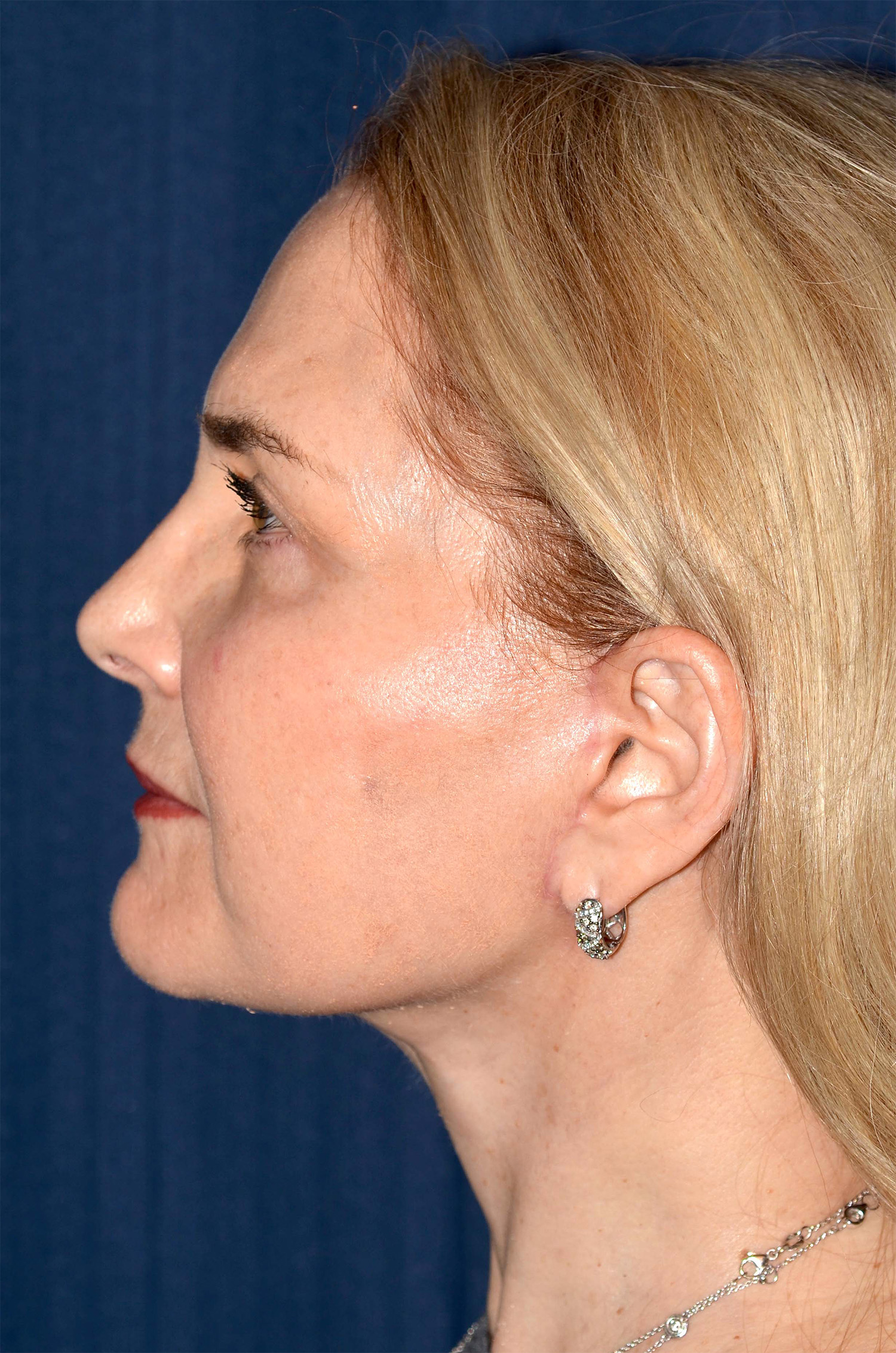 Facelift / Neck Lift