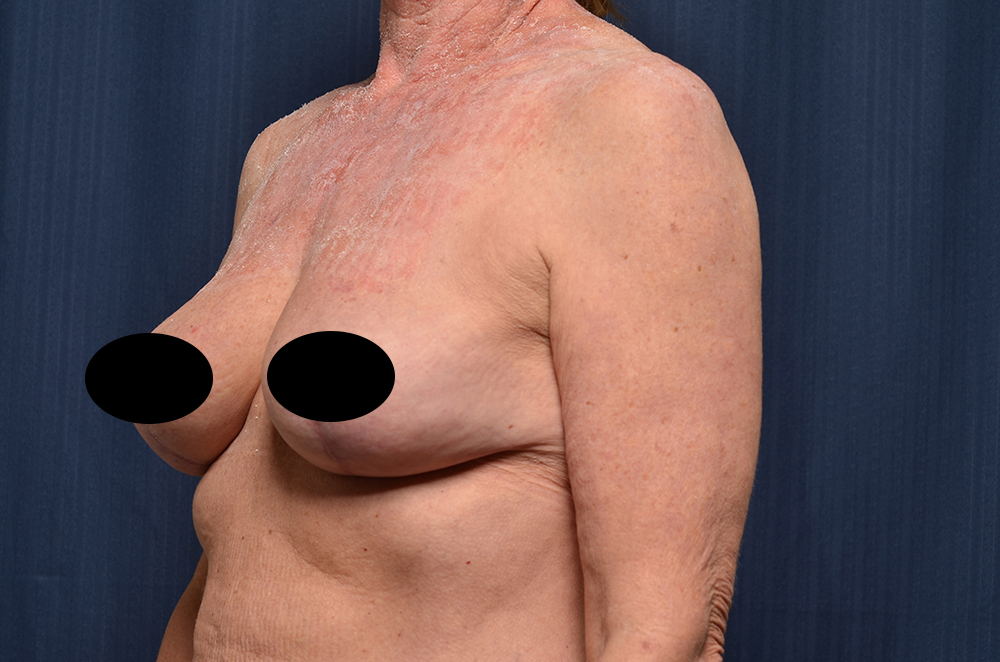 Breast Lift Reduction