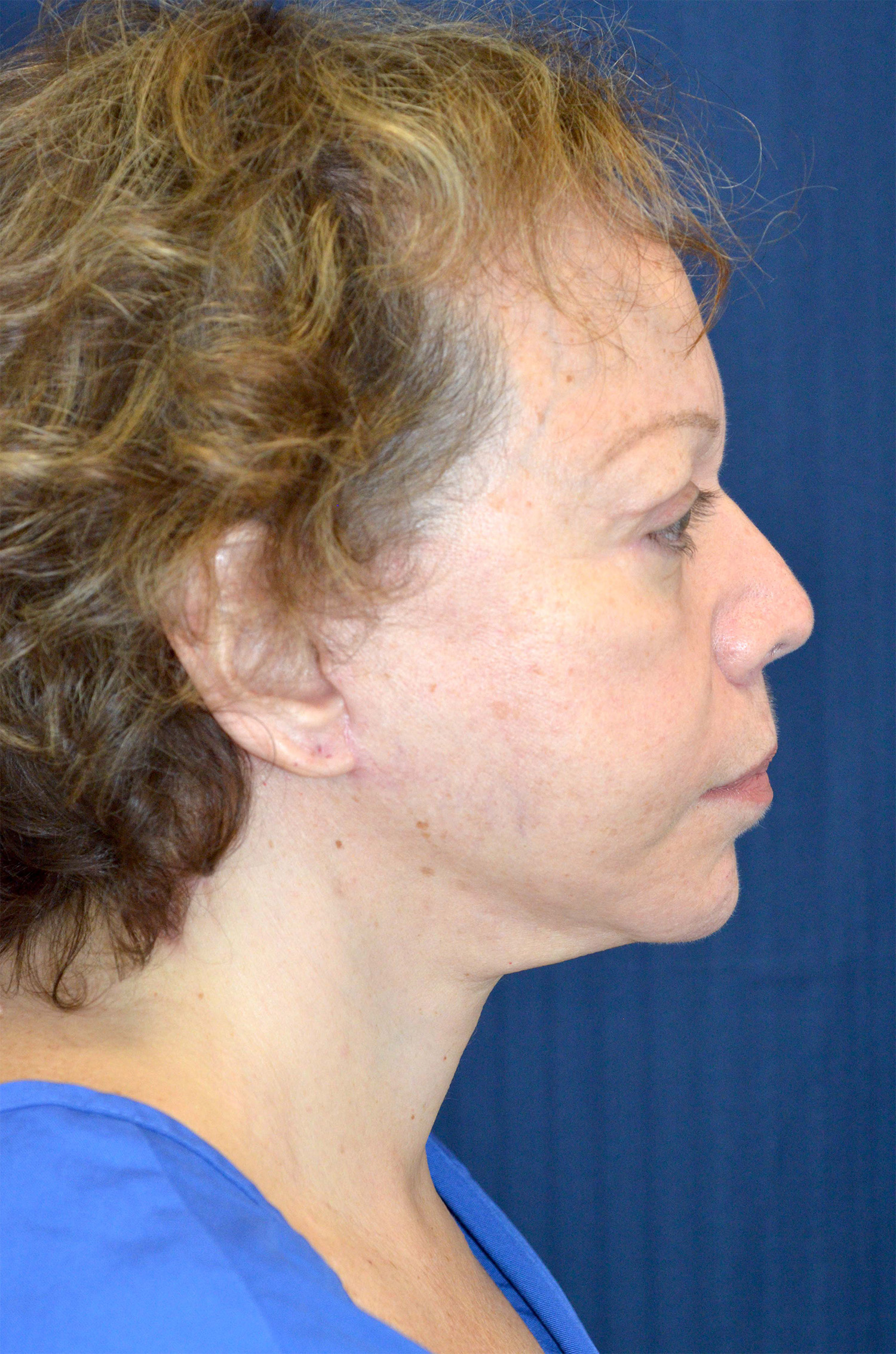 Facelift / Neck Lift