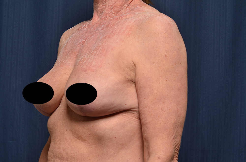 Breast Lift Reduction