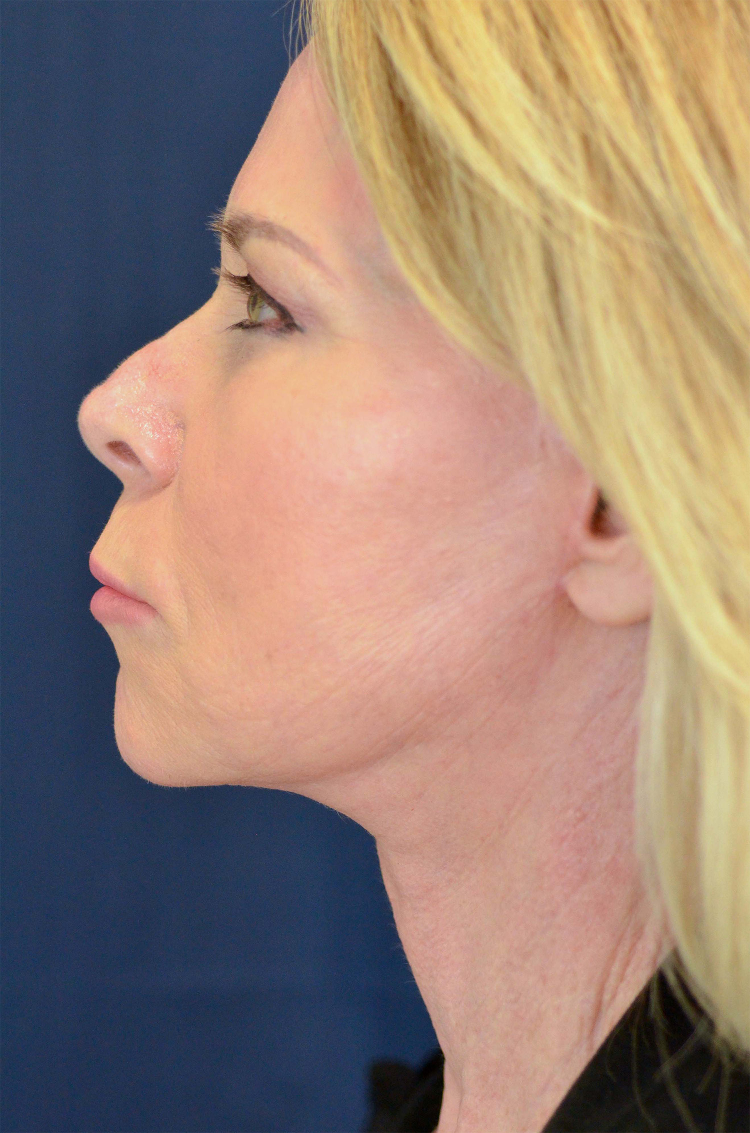 Facelift / Neck Lift