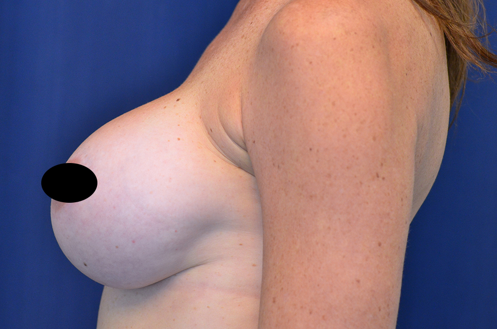 Breast Implant Revision