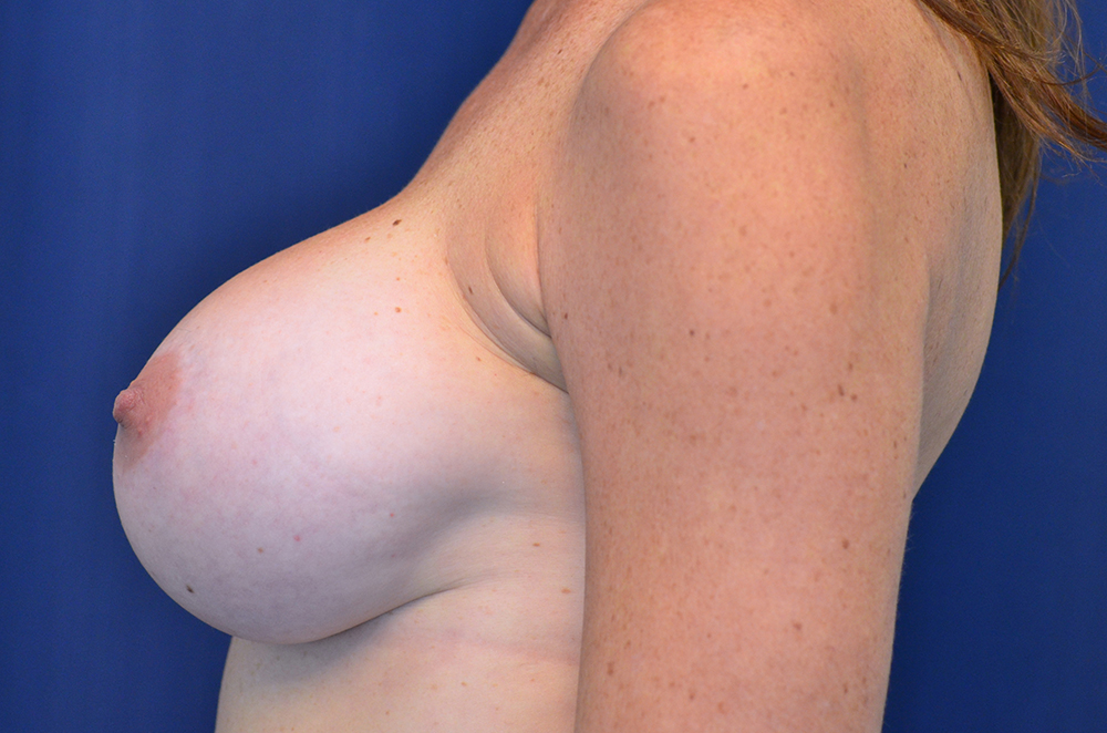 Breast Implant Revision
