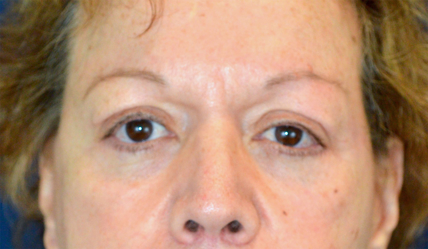 Eyelid Lift / Brow Lift