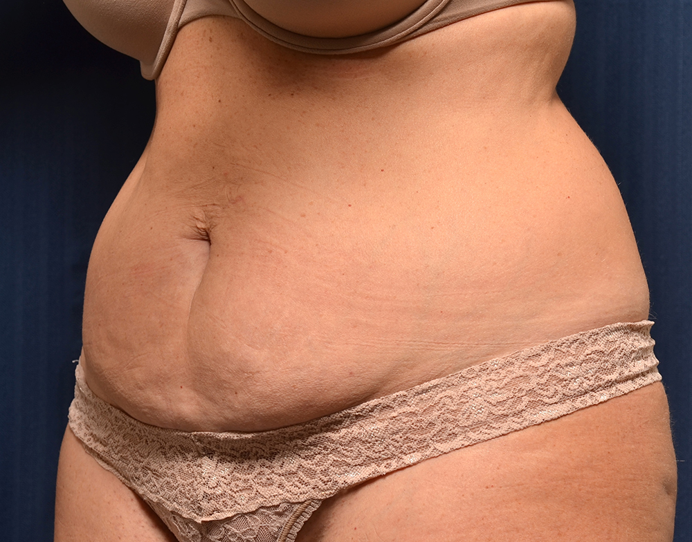 Tummy Tuck