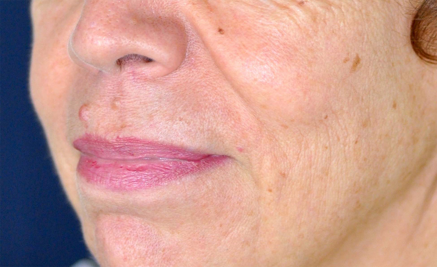 Lip Augmentation / Lip Lift