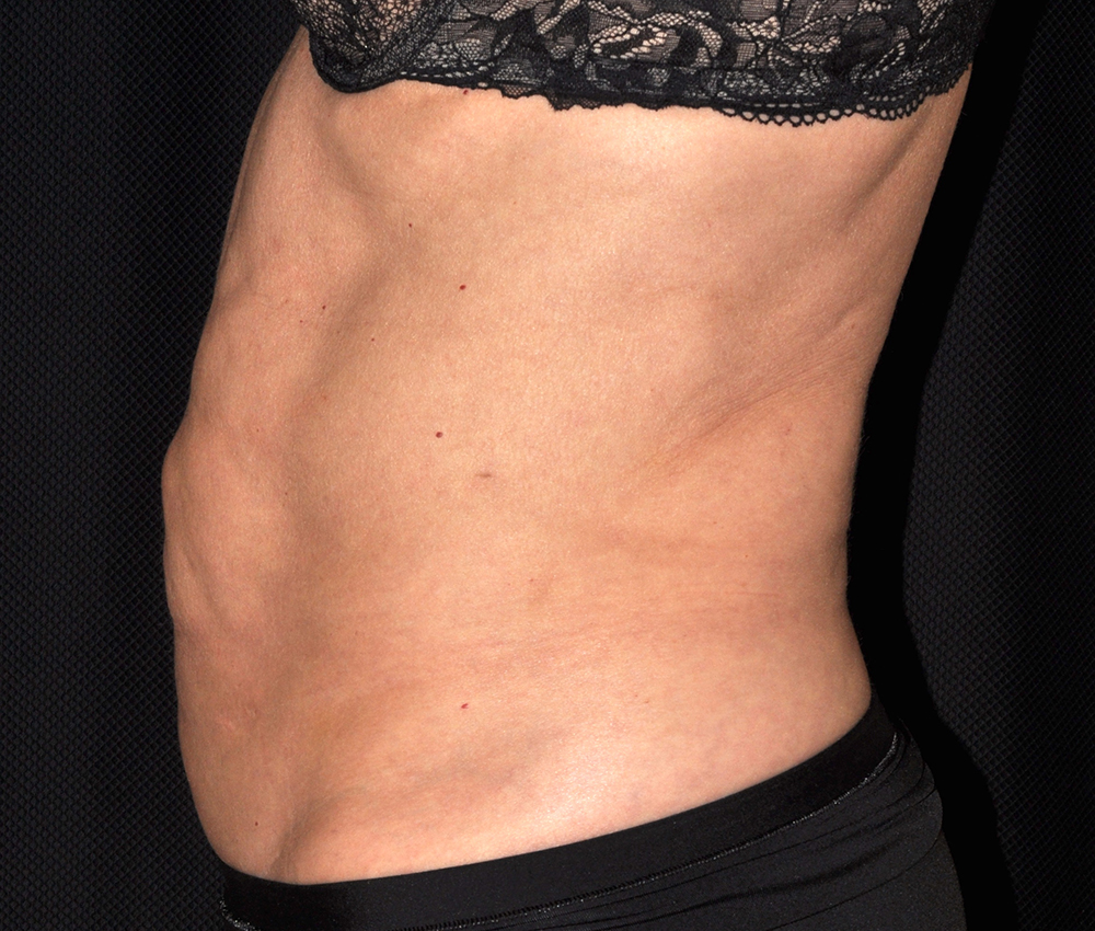 Tummy Tuck