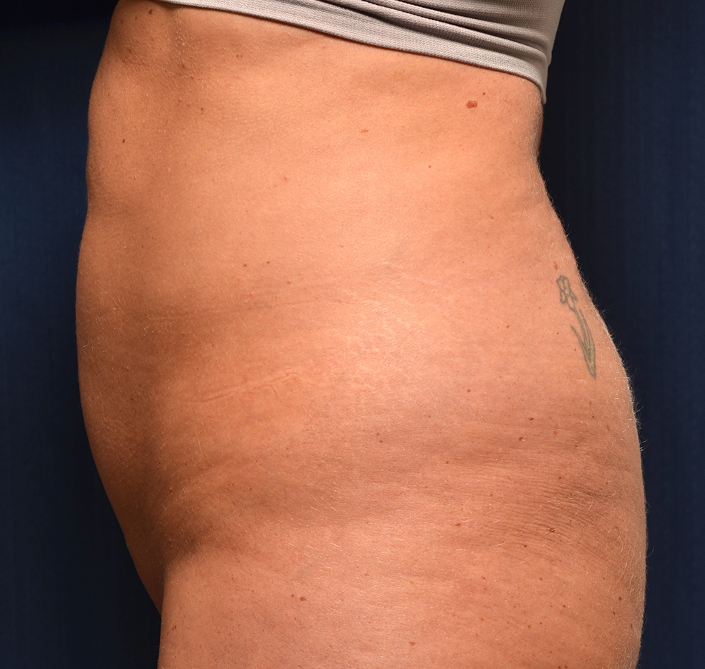 Tummy Tuck