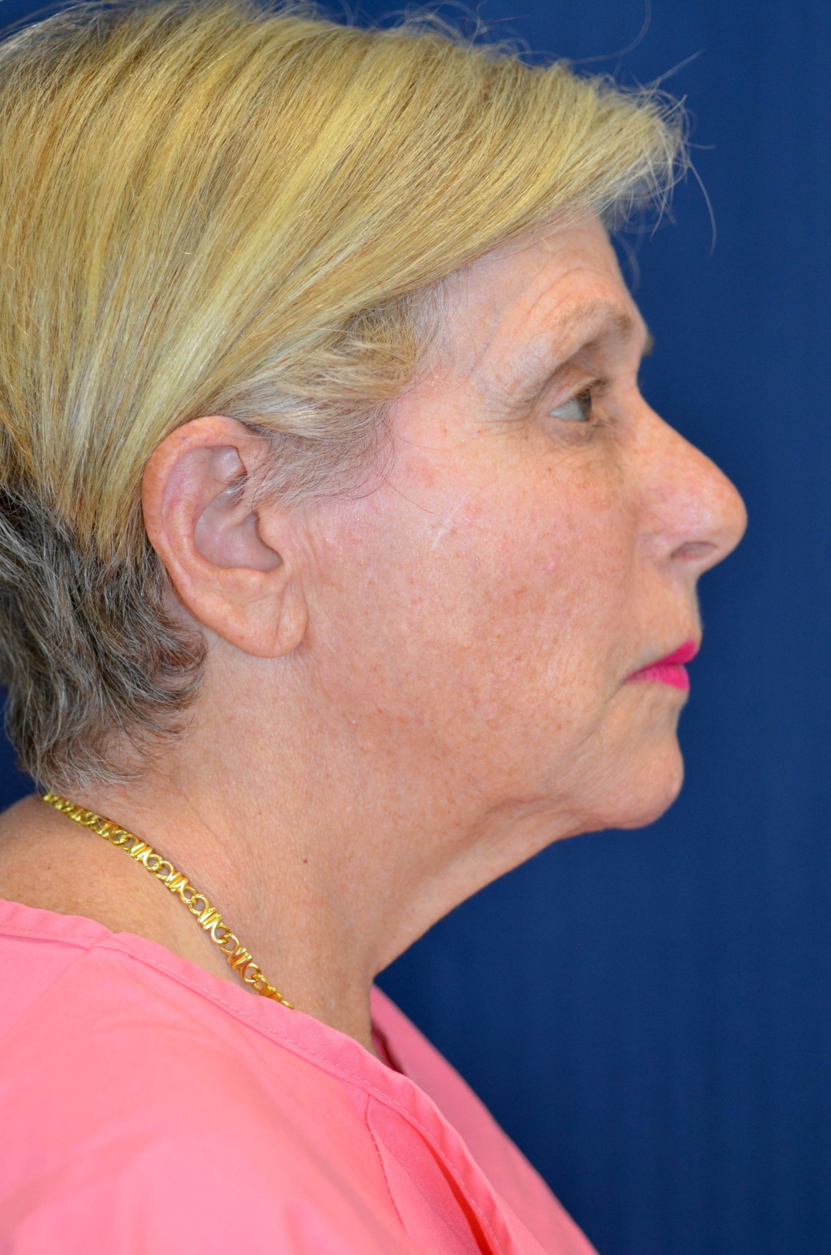 Facelift / Neck Lift