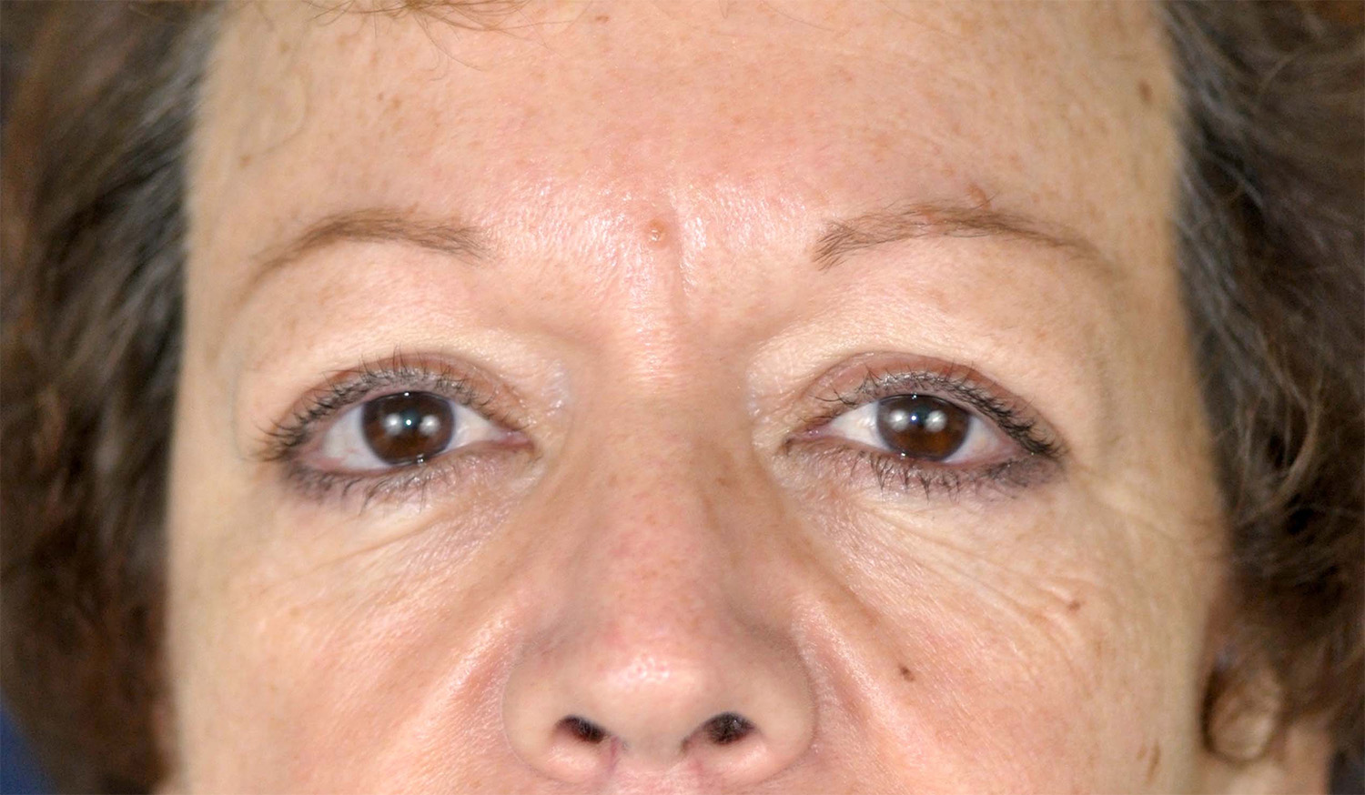 Eyelid Lift / Brow Lift