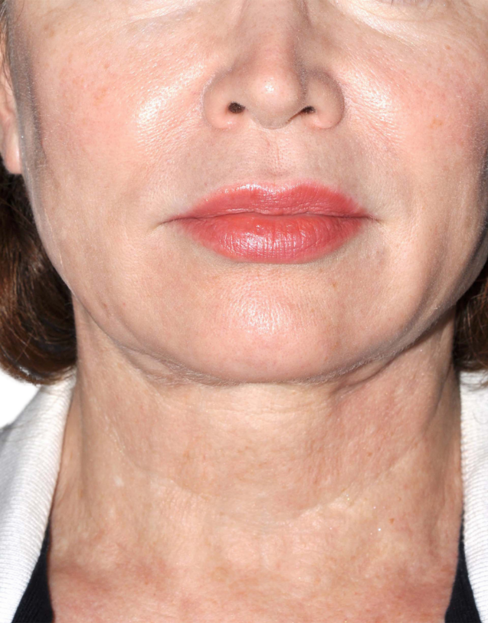 Facelift / Neck Lift