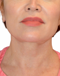 Le Spa Plastic Surgery Before and After Photos