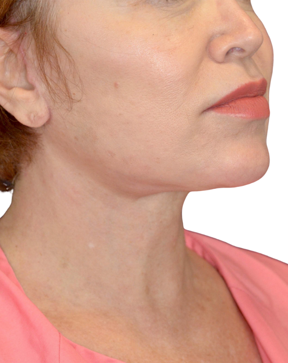 Facelift / Neck Lift