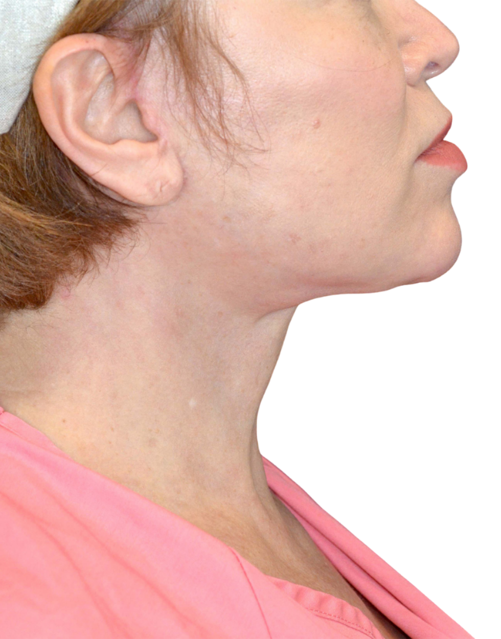 Facelift / Neck Lift