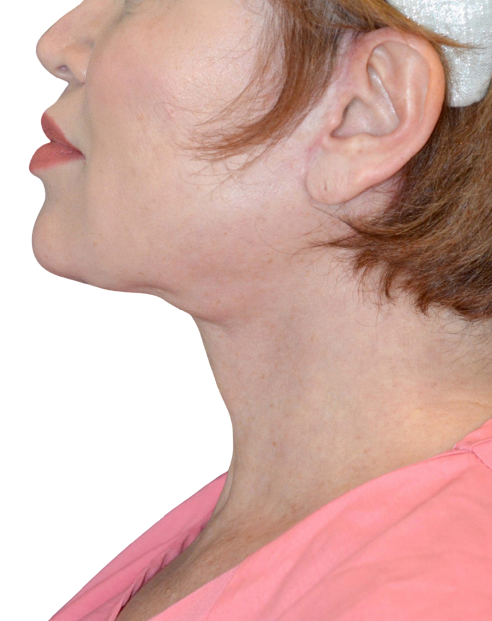 Facelift / Neck Lift