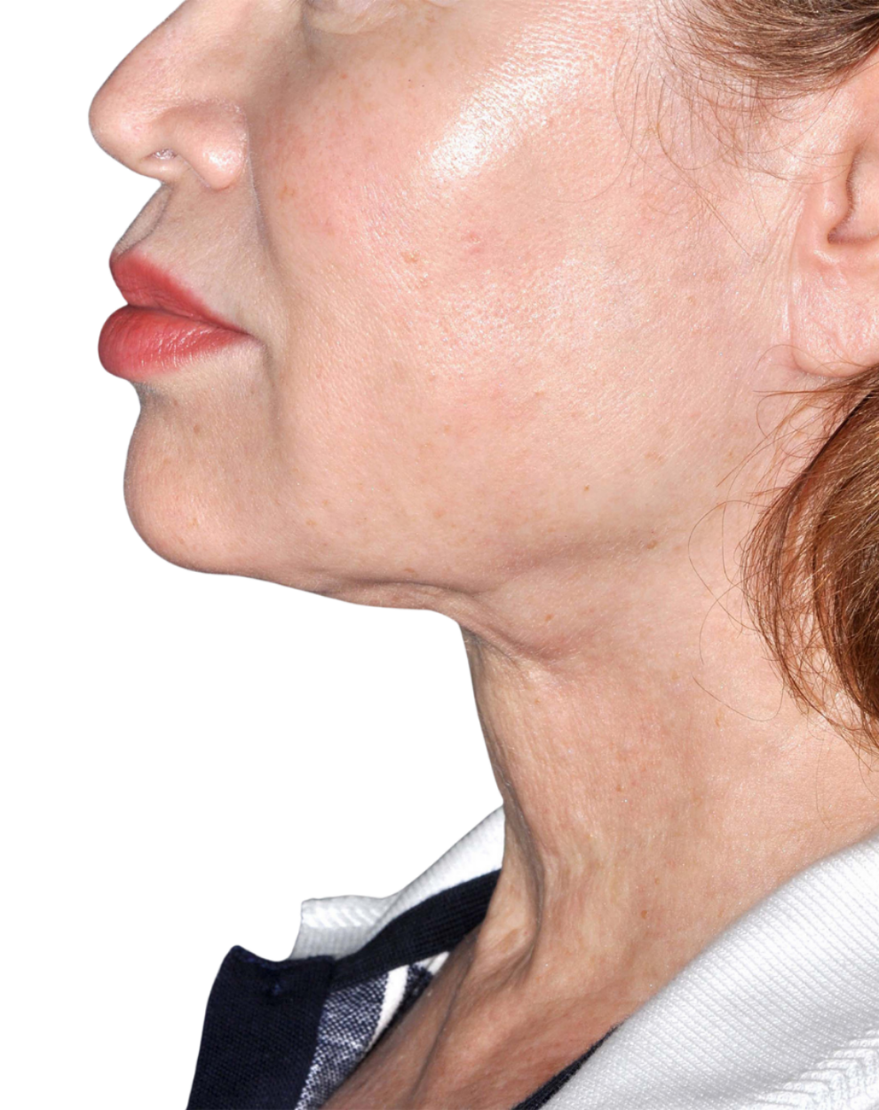 Facelift / Neck Lift