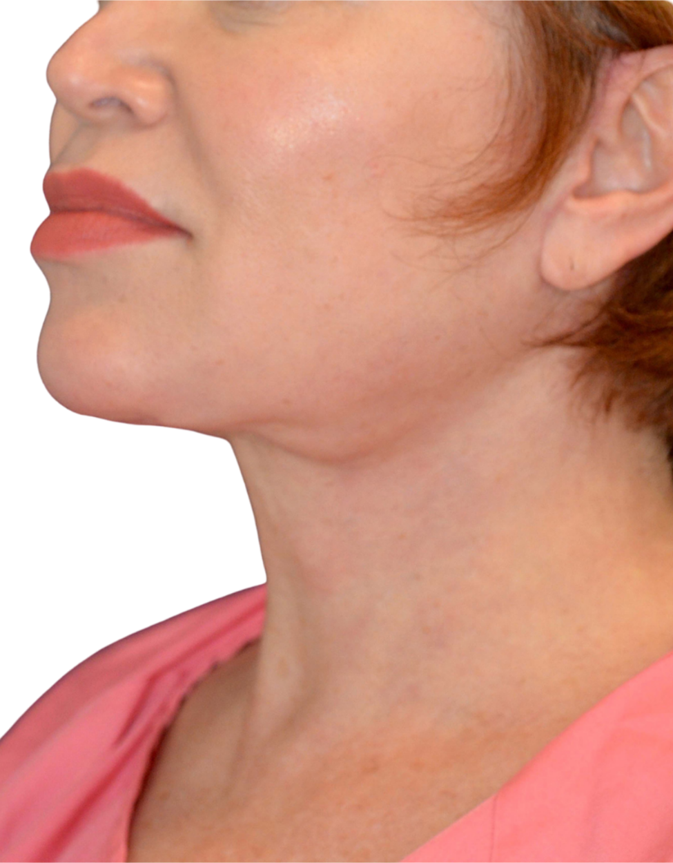 Facelift / Neck Lift