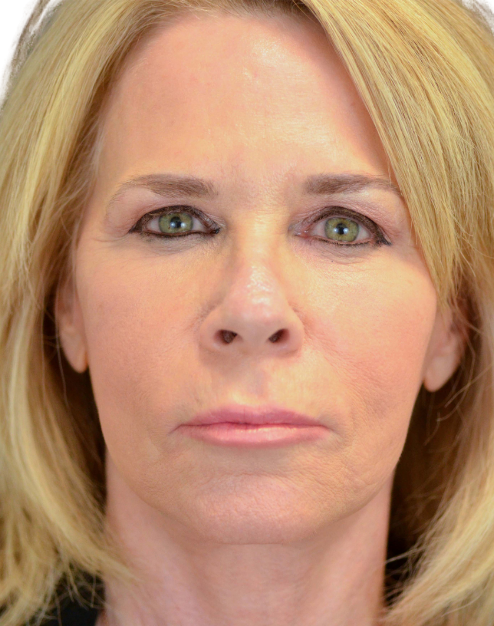 Facelift / Neck Lift