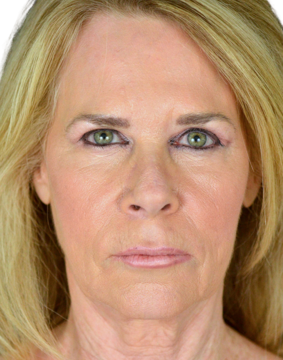 Facelift / Neck Lift