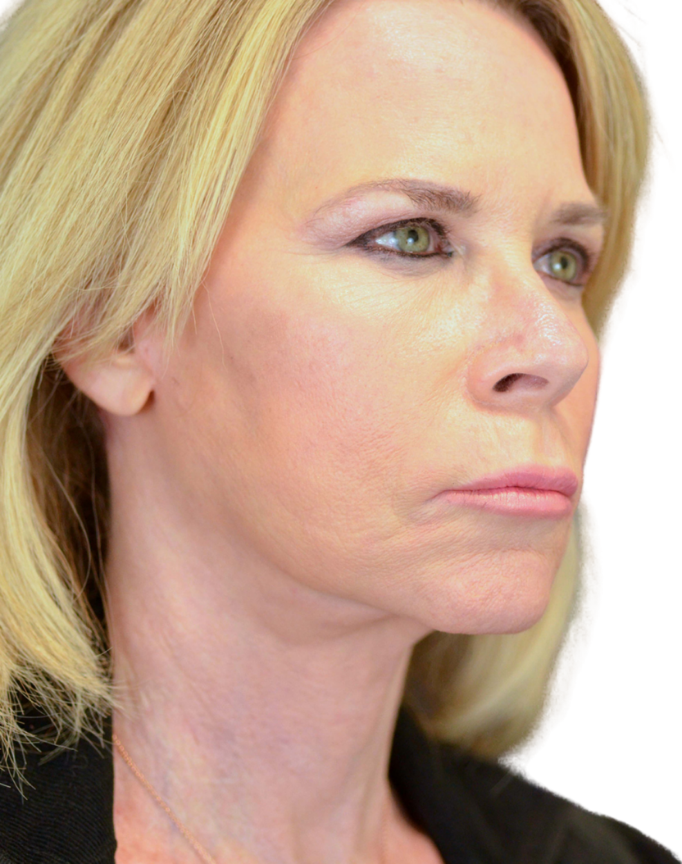 Facelift / Neck Lift