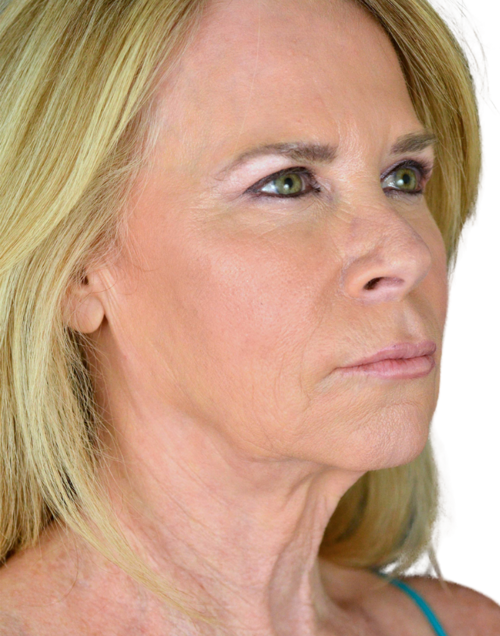 Facelift / Neck Lift