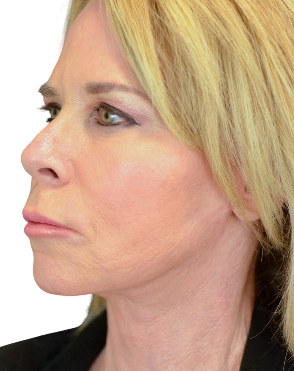 Facelift / Neck Lift