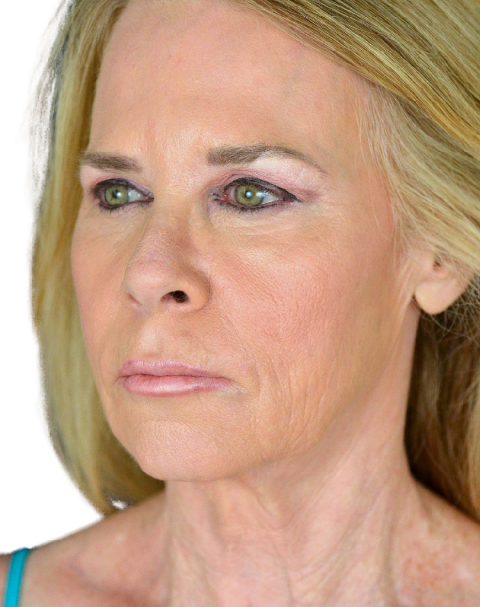 Facelift / Neck Lift