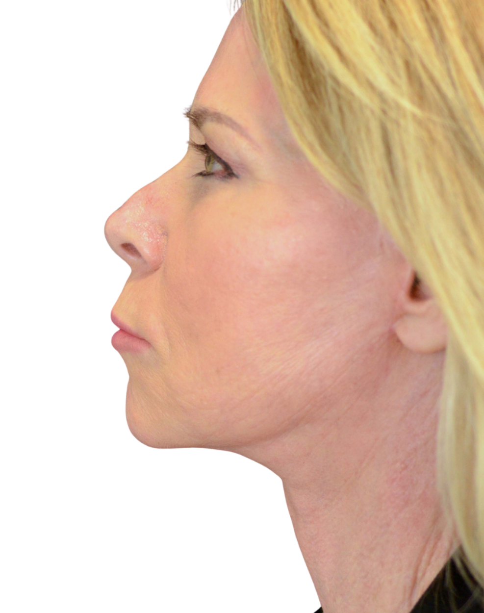 Facelift / Neck Lift