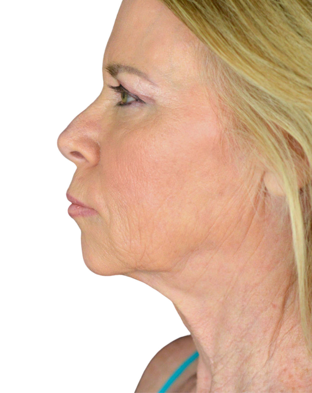 Facelift / Neck Lift