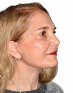 Le Spa Plastic Surgery Before and After Photos