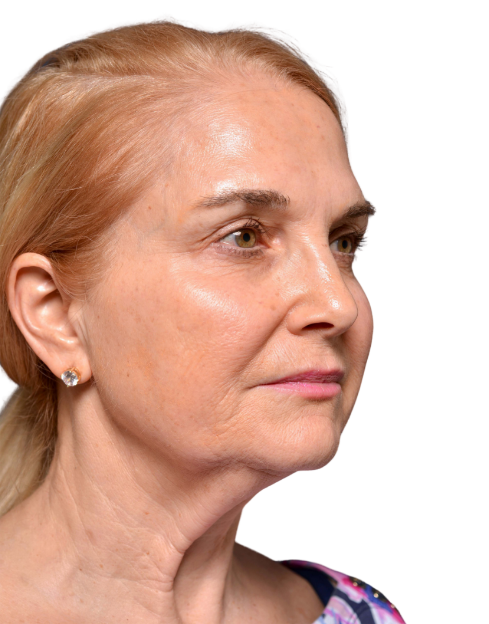 Facelift / Neck Lift