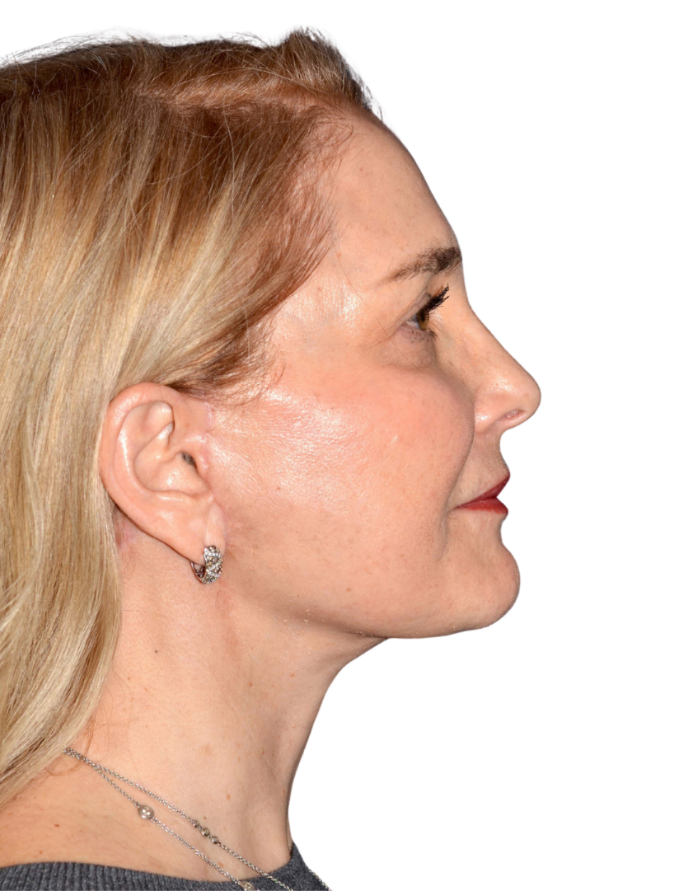 Facelift / Neck Lift