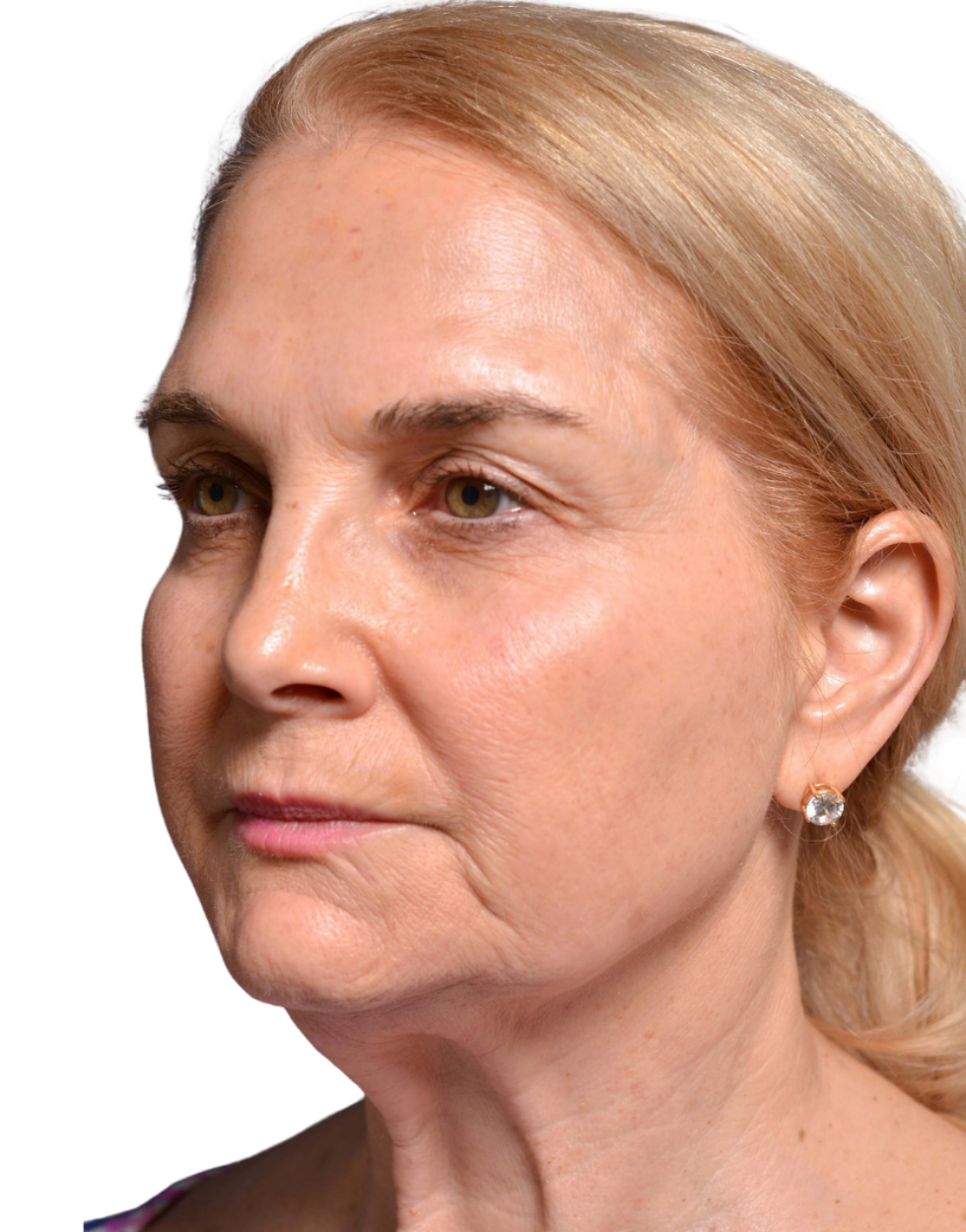 Facelift / Neck Lift