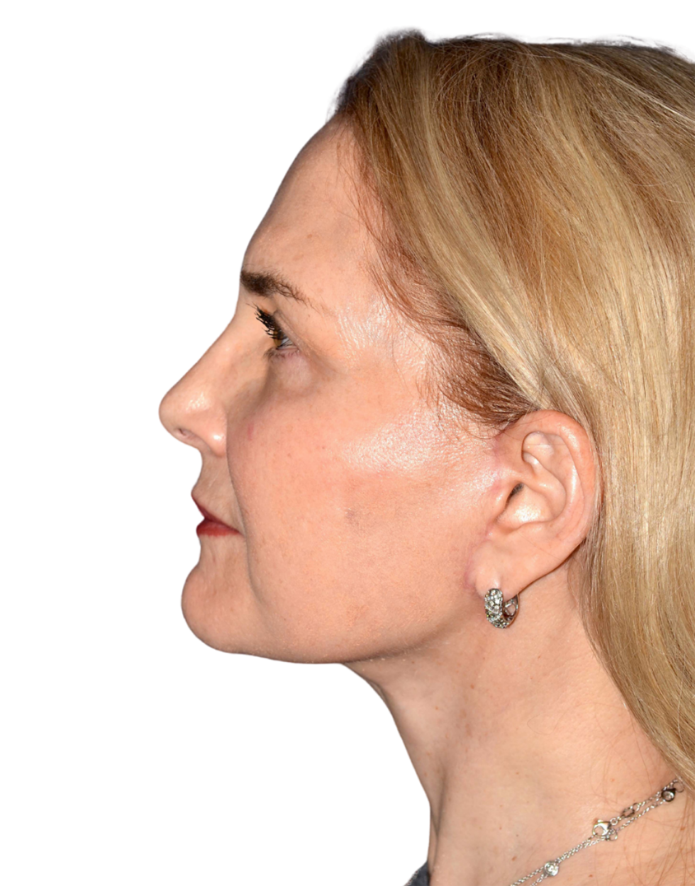 Facelift / Neck Lift