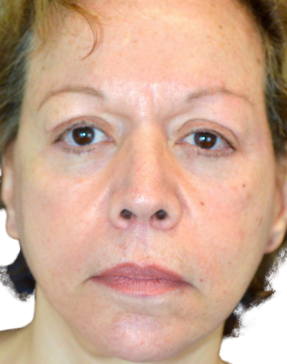 Facelift / Neck Lift
