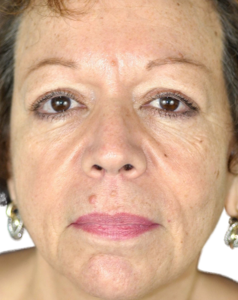 Facelift / Neck Lift