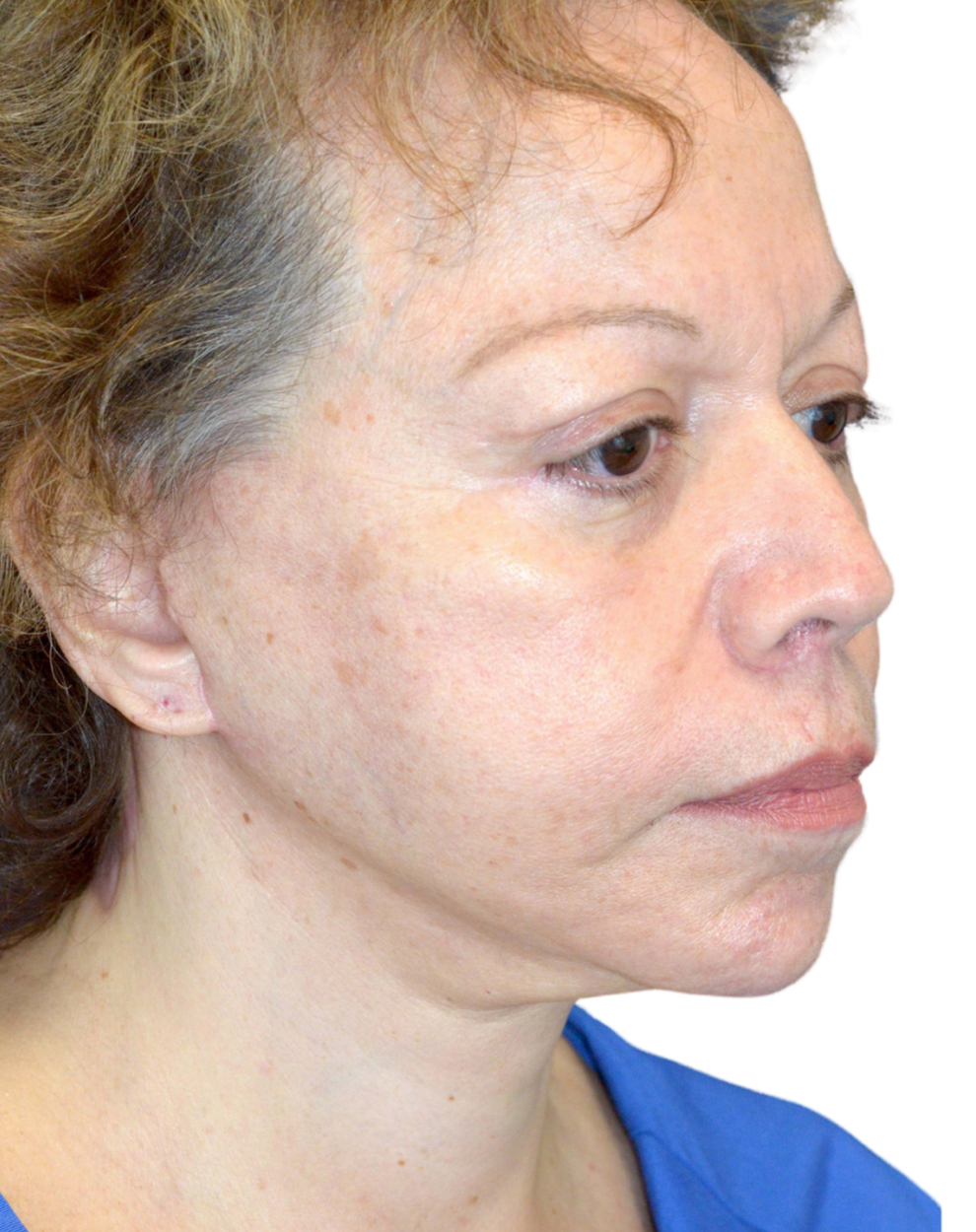 Facelift / Neck Lift