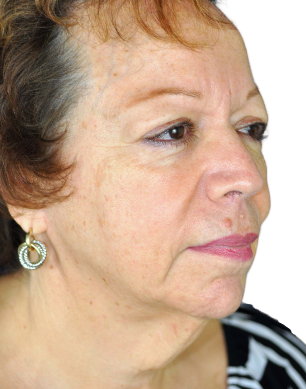 Facelift / Neck Lift