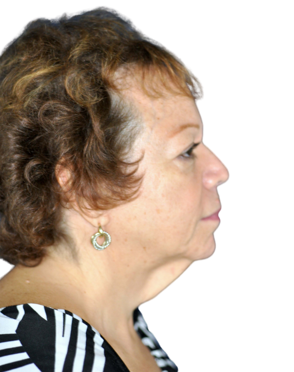 Facelift / Neck Lift