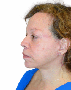 Le Spa Plastic Surgery Before and After Photos